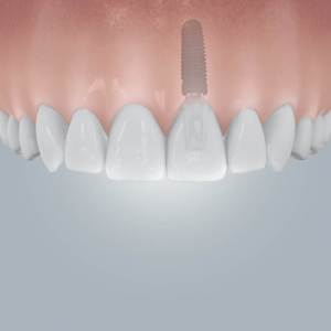 csm_camlog_einzelzahnluecke_mit_implantatversorgung_01_0d1c2fc5a1